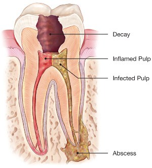 Infected Tooth Pearlfection Dentistry